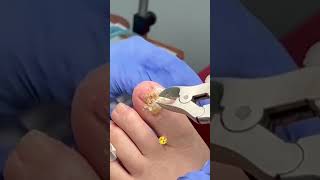 Fungal toenail debridement nails footcare beautiful [upl. by Philippine]