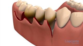 Periodontal flap approach surgery [upl. by Hartzke]