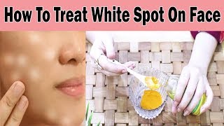 One Way To Get Rid Of White Spots On Face [upl. by Lattonia]