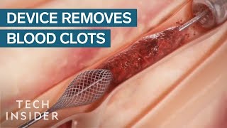 How This Device Safely Removes Blood Clots  Tech Insider [upl. by Schinica]