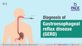 Diagnosis of Gastroesophageal Reflux Disease GERD Dr Phani Krishna Ravula [upl. by Largent]