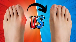 How To Fix A Bunion In 5 Steps [upl. by Sidnak]