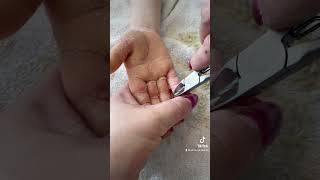 Removing callus from kid hands  Keratoderma hyperkeratosis EPPK skin shaving callous  Mar 30 2023 [upl. by Wilmar]