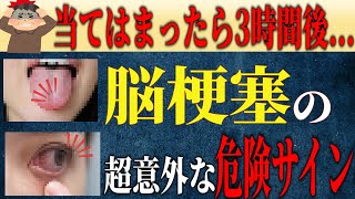 【脳梗塞】になりかけてる人に共通する前兆7選！見逃したら終わり【放置厳禁】 [upl. by Adele]