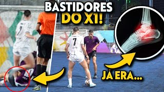 JUNINHO MANELLA vs ÉOACRE LESÃO CONFIRMADA  BASTIDORES DO X1 [upl. by Nueormahc]