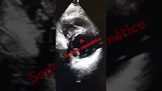 ANTEROSEPTAL FACE INFARCTION echocardiogram infarto anteroseptal [upl. by Nauqram377]