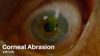 Eye injuries Corneal abrasion [upl. by Kisung62]