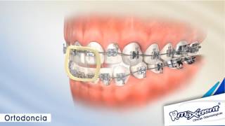 Corrección de mordida y espacios dentales quotOrtodonciaquot [upl. by Oivlis]