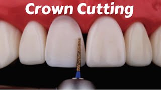 Crown Tooth Preparation Cutting for Anterior Incisor PFM Zirconia Ceramic Emax  Prostho Lecture [upl. by Curkell364]