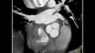 4D Imaging of the Aortic Valve 3D and 4D rendering of the heart 1 of 3 [upl. by Kamp]