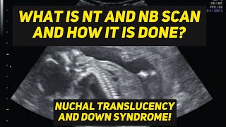 NT and NB scan  Nuchal translucency scan  Learn Ultrasound Techinques [upl. by Asiram110]