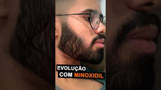 10 MESES de tratamento com MINOXIDIL evolução com minoxidil barba minoxidil [upl. by Delilah]