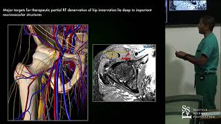 Genicular Acetabular amp SI Joint Denervation Procedures  Ramana Naidu MD [upl. by Inattirb]