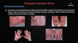 Porphyria cutanea tarda PCT  Biochemistry usmle step 1 webinar lecture [upl. by Eelinnej]