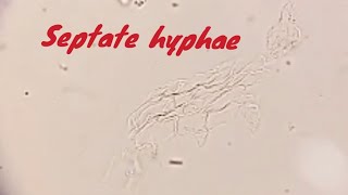 Septate hyphae Skin Fungal KOH preparation [upl. by Ibbob]