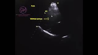 Echocardiography Sigmoid septum [upl. by Attelrahc]