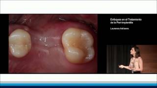 Enfoques en el Tratamiento de la Periimplantitis  Laurence Adriaens [upl. by Namyac]