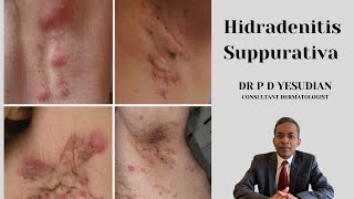 Hidradenitis suppurativa  pathogenesis and management [upl. by Aitra]