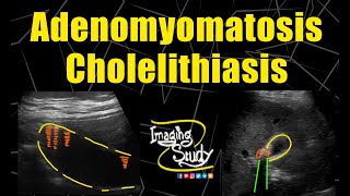 Adenomyomatosis amp Cholelithiasis  Ultrasound  Case 183 [upl. by Etteuqram]