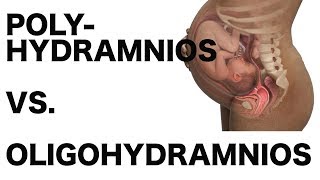 Polyhydramnios vs Oligohydramnios [upl. by Vanny]