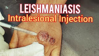 Leishmaniasis Treatment [upl. by Llenrub566]