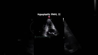 Hypoplastic posterior mitral valve leaflet  APLAX [upl. by Oletta]