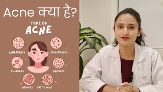 What is Acne  Types Of Acne  Acne Treatment [upl. by Patric]