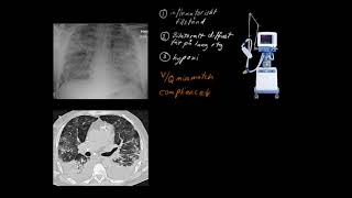 Respiratorsik svikt 14 ARDS [upl. by Nitas]