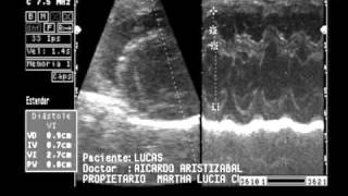 insuficiencia valvular mitral y tricuspideawmv [upl. by Mohr229]