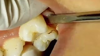 Extraction of upper first Premolar for orthodontics ttt [upl. by Eamanna486]