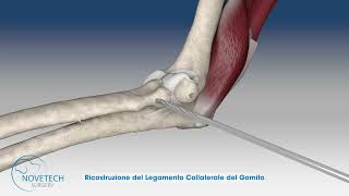 Ricostruzione del Legamento Collaterale Laterale del Gomito con NOVALIG® [upl. by Seraphim]