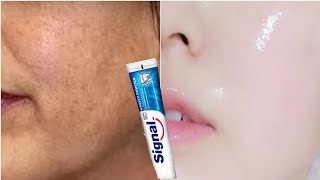 Le dentifrice est le moyen le plus rapide d’éliminer la pigmentation et le mélasma en deux jours 💯 [upl. by Nuhsal]