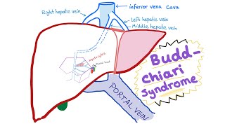 BuddChiari syndrome  Definition Causes Pathophysiology Diagnosis amp Treatment  Hepatology [upl. by Fricke]