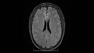 MRI showing progressive multifocal leukoencephalopathy [upl. by Nahbois]