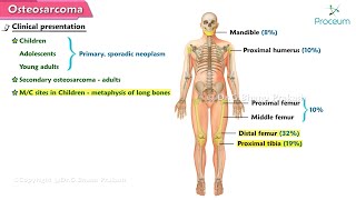 Osteosarcoma 🦴  Orthopedic lectures [upl. by Eiuqcaj]