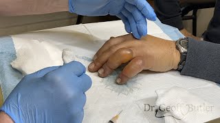 Drainage of blisters secondary to frostbite [upl. by Howlond]