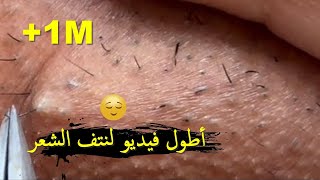 أطول فيديو لعملية إزالة الشعر تحت الجلد وتنظيف البشرة INGROWN HAIR REMOVAL [upl. by Rod]