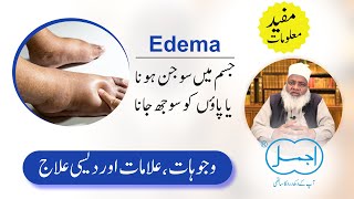 Edema Causes Symptoms and Treatment in Urdu  Swelling Feet  Oedema  Jism me Sojan ka ilaj [upl. by Assereht58]