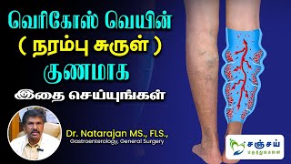 What is Varicose Veins and Its Treatment Options Varicose Veins in Tamil வெரிகோஸ் வெயின் சிகிச்சை [upl. by Renae]