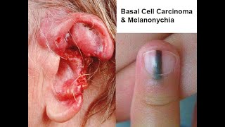 Basal Cell Carcinoma amp Melanonychia Nail Lines Updated [upl. by Ellecram976]