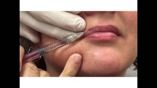 Lip Enhancement with Dr Carlos Wolf [upl. by Alecram]