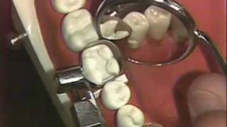 Packing of Class II Amalgam for Hygienists [upl. by Essiralc]