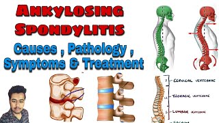 Ankylosing Spondylitis  Cause  Pathology  Symptoms  Treatment Nursing Lecture in Hindi MSN 1 [upl. by Eeramit]