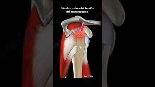 LESIÓN EN EL HOMBRO ROTURA DEL TENDÓN SUPRAESPINOSO futbol loquedebesconocerdetucuerpo anatomy [upl. by Epstein38]