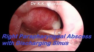 Right Parapharyngeal Abscess with Discharging Sinus  Endoscopic View [upl. by Publias]