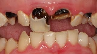 Home Remedies to Get Rid of Abscess Tooth [upl. by Nniroc378]