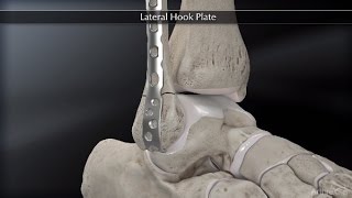 Lateral Hook Plate [upl. by Nwahsit668]