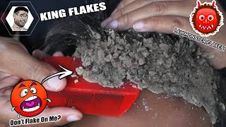 Dandruff combing Big Flakes  Scratching Dandruff And Picking Psoriasis Off Scalp 154 [upl. by Kermit]