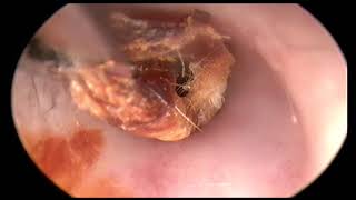 Gros bouchon de cérumen earwax removal Dr JB Danvin [upl. by Ecinaj779]