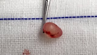 Epididymal Cyst [upl. by Ateekan424]